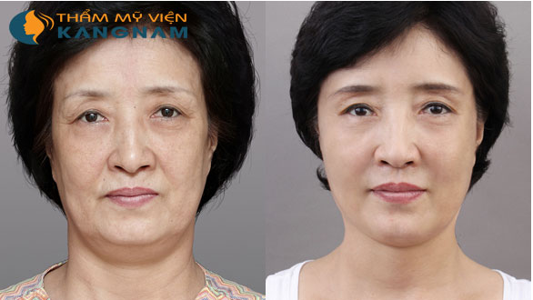 cang-da-tran-co-dau-khong-chuyen-gia-tu-van21