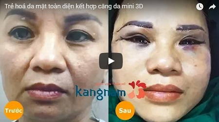 Trực tiếp chứng kiến toàn cảnh ca trẻ hoá da mặt toàn diện căng da mini 3D tại Kangnam