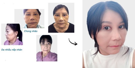 Hình ảnh so sánh trước và sau khi căng da của Nguyễn Thị Như1
