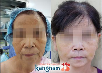 hình ảnh khách hàng căng da mặt bằng Thermage tại kangnam