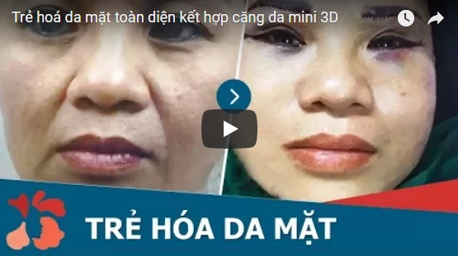 [Video] Căng da mặt 3D – Loại bỏ nếp nhăn toàn da mặt
