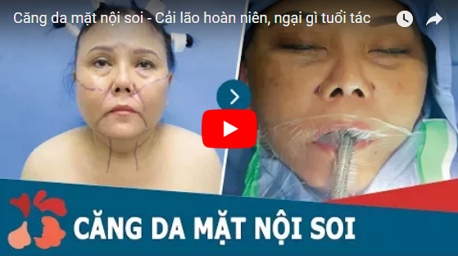 [Video] Cận cảnh quy trình – kết quả căng da mặt Nội Soi